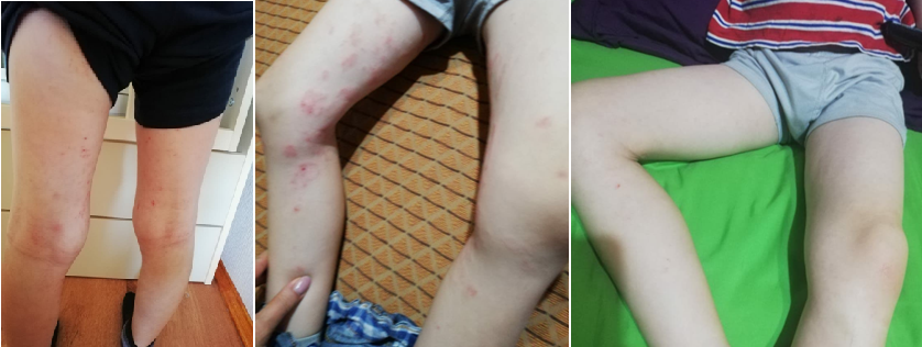 Атопический дерматит
